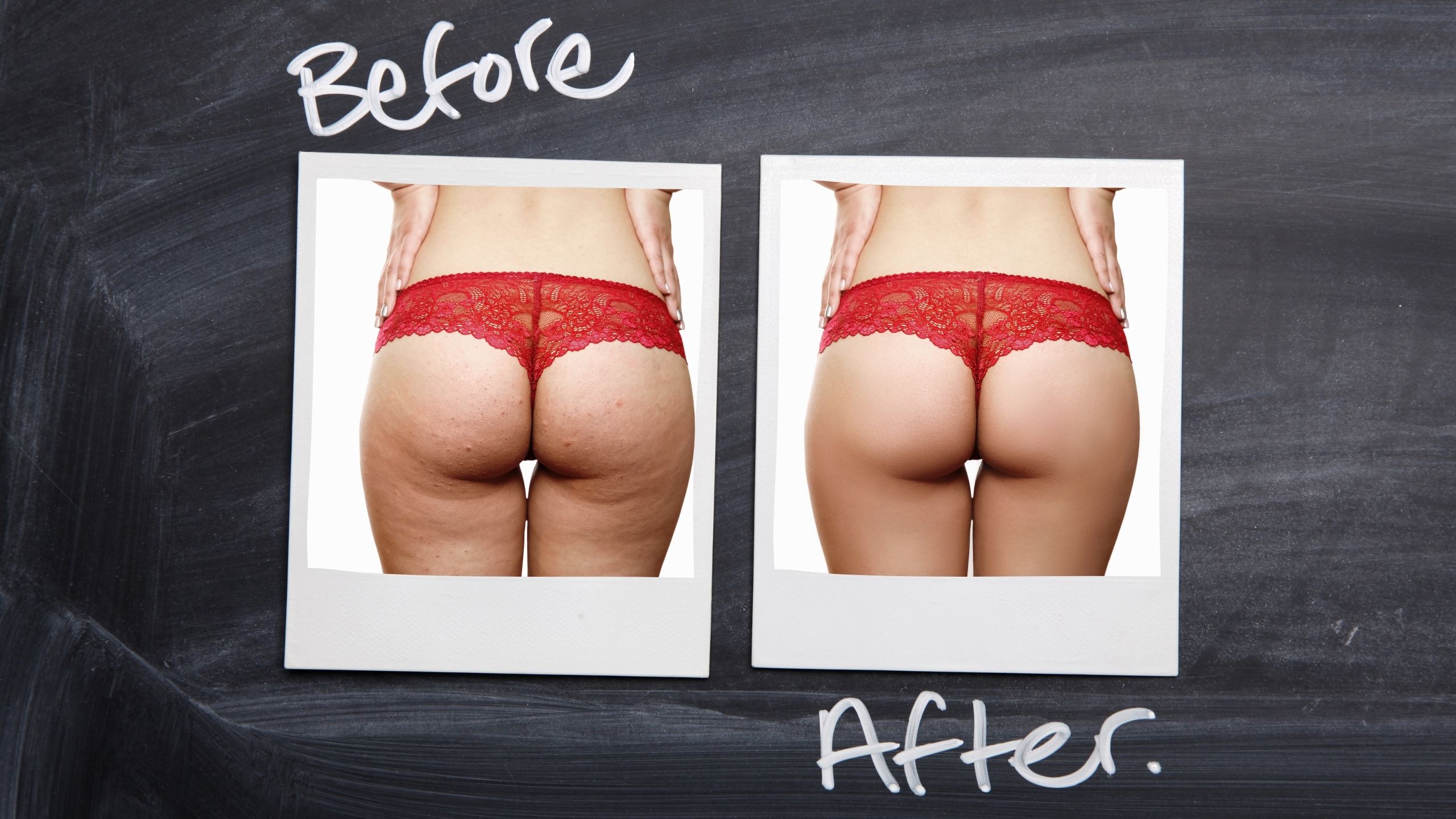 cellulite before after