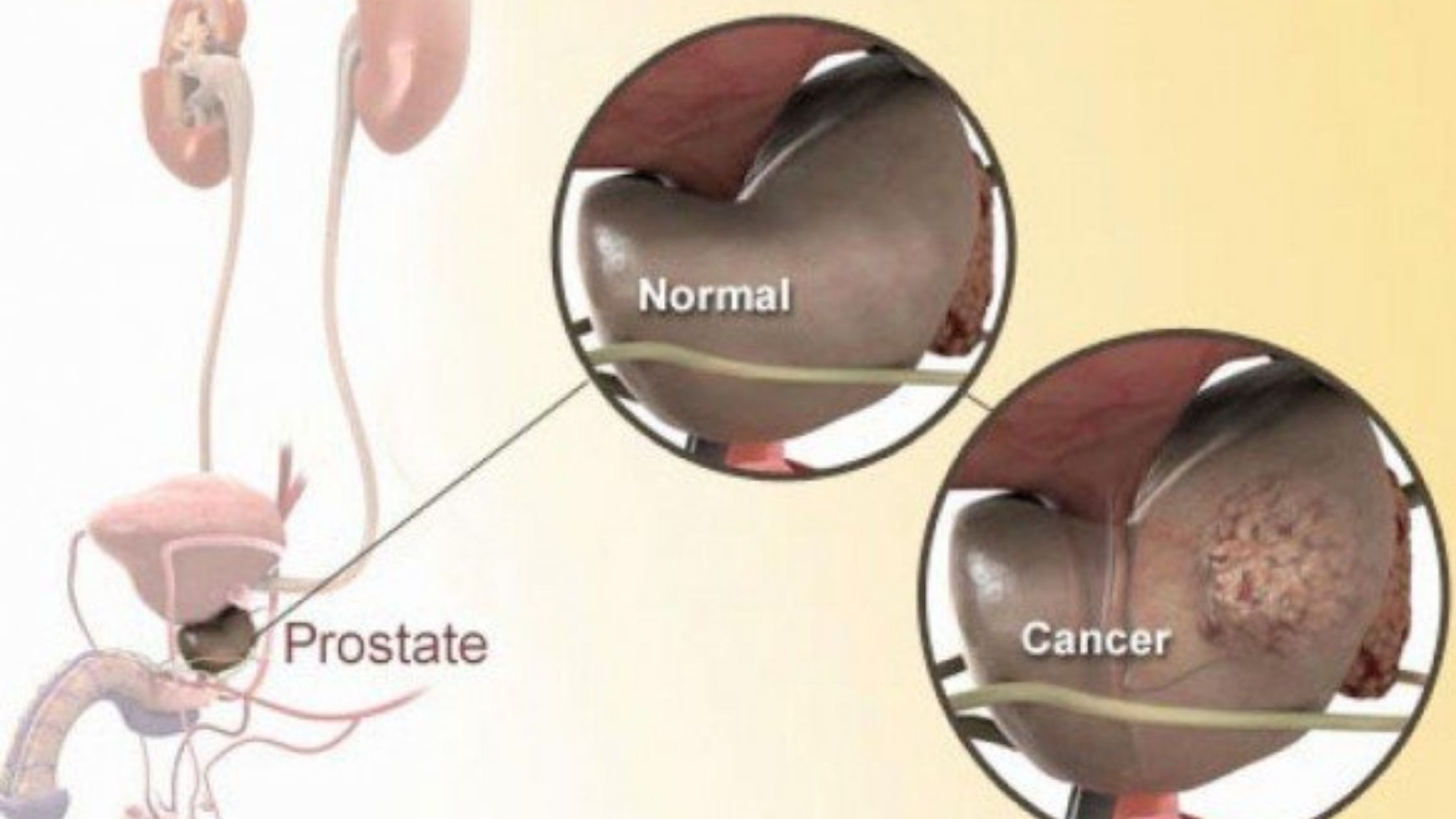 Treatments for prostate cancer or enlarged prostate