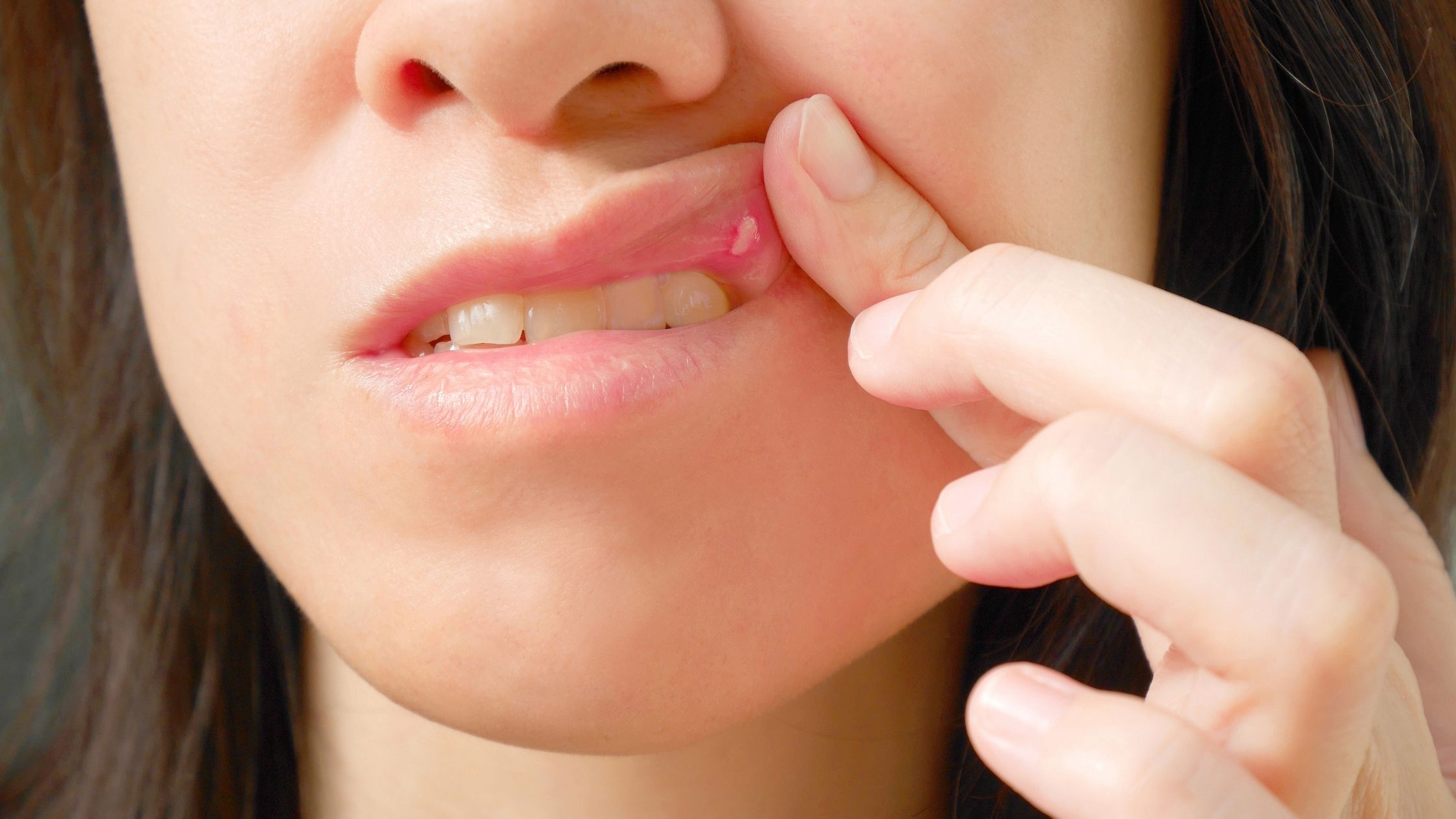 Canker Sore Causes