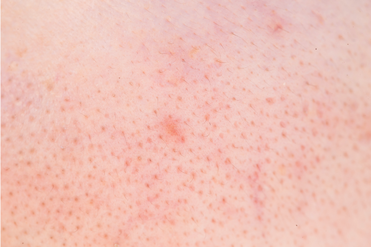 Location of acne
