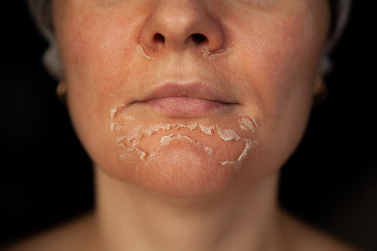 Facial scar treatment