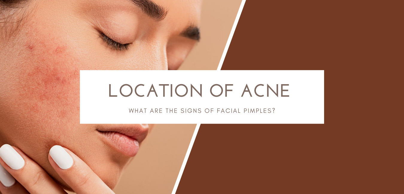 Location of acne